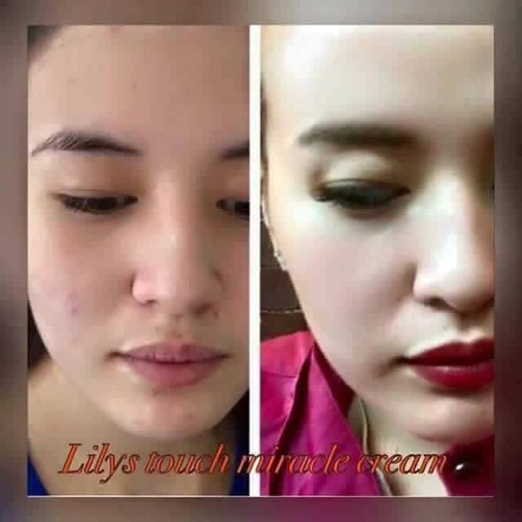 Lily Touch Miracle Cream Anti-Acne Aging Benefits - Picture 8 of 8